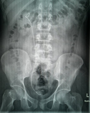 Plain X-Ray of urinary tract (kidney, ureter and urinary bladder) anteroposterior view showing right ureteric stent  (DJ stent) used to treat stones