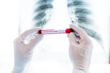 Hands holding a test tube containing a blood sample for COVID-19 testing against a chest x-ray