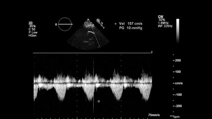 Image of the heart in gray-scale mode during transesophageal ultrasound.