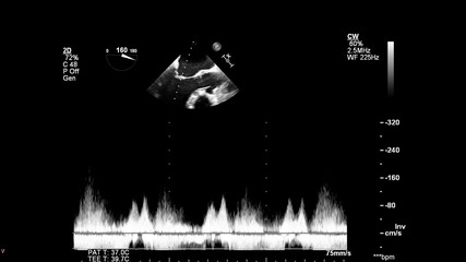 Image of the heart in gray-scale mode during transesophageal ultrasound.