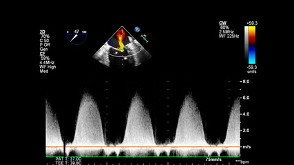 Image of the heart during transesophageal ultrasound with Doppler mode.