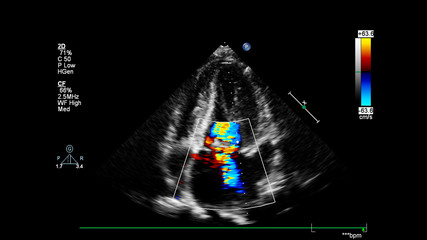 Image of the heart during transesophageal ultrasound with Doppler mode.