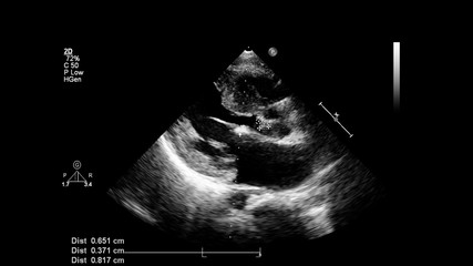 Image of the heart in gray-scale mode during transesophageal ultrasound.
