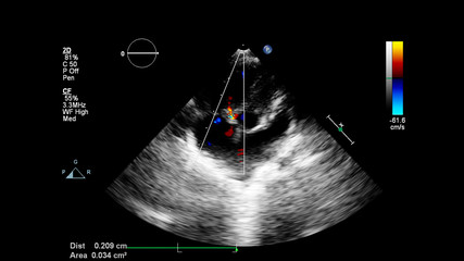 Image of the heart during transesophageal ultrasound with Doppler mode.