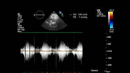 Image of the heart during transesophageal ultrasound with Doppler mode.