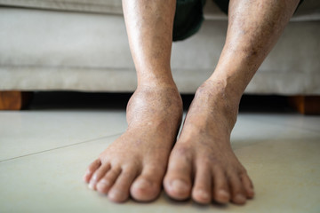 Asian senior woman is show her swollen feet or legs in the area of astragalus,elderly patient with...