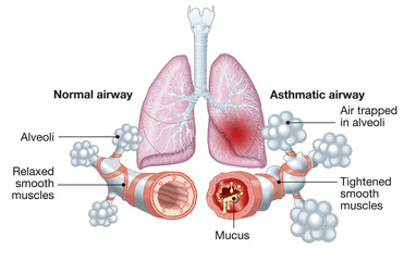 Asthma, normal and asthmatic airways, medically illustration