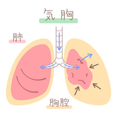 肺の図表（気胸）