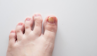 Fungus on the nail. Fungal disease on the toe. Medicine, treatment