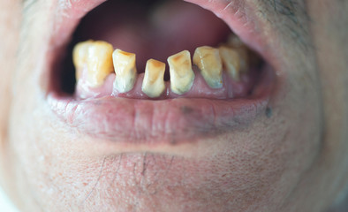 The image of the teeth of an elderly person that is not beautiful, there is a problem of dirt,...