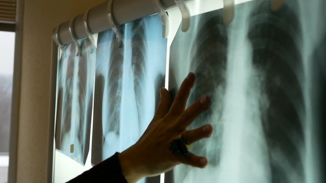 fluorography of coronavirus lungs of patients. pneumonia