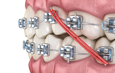 Elastics and metal braces for correction dental bite . Medically accurate dental 3D illustration