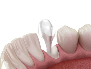 Stump pin tab on canaine tooth. Medically accurate dental 3D illustration