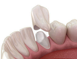 Stump pin tab on canaine tooth. Medically accurate dental 3D illustration