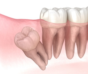Distal impaction of Wisdom tooth. Medically accurate tooth 3D illustration - obrazy, fototapety, plakaty