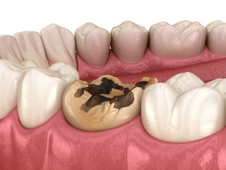 Caries removing process. Medically accurate tooth 3D illustration.