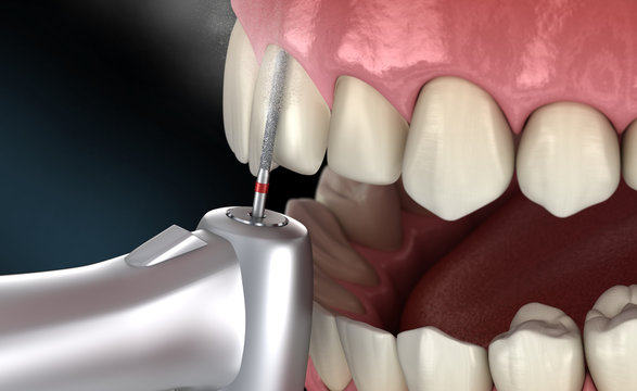 Central Incisor preparation process for dental Veneer placement. Medically accurate 3D illustration