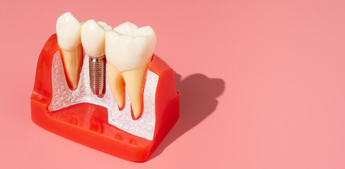 Example of Implants and dental tools for use in explaining.