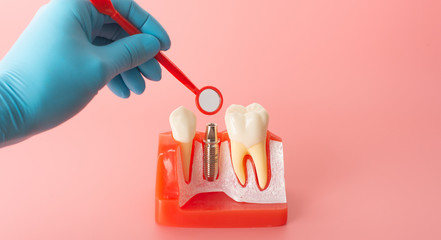 Example of Implants and dental tools for use in explaining.