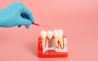 Example of Implants and dental tools for use in explaining.