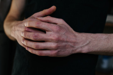 Fototapeta premium Cracked, flaky skin on the hands. Dermatological problems of psoriasis. Hard, cracked skin on the finger in a woman's hands. Hand stains, dry skin. Psoriasis, allergy