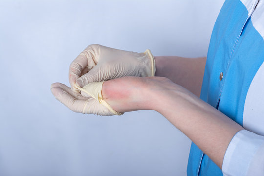 a nurse in uniform removes rubber medical disposable gloves from her hands. Redness is visible on the skin of the hand, a sign of allergy. protection against coronavirus, bodily contact