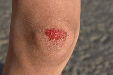 bruised wound on the knee, the boy fell and scratched his knee
