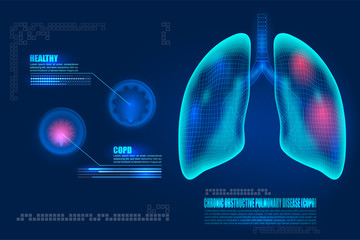 Healthcare futuristic technology Human lungs with COPD chronic obstructive pulmonary disease. Lungs inflammation symptoms causes diagram. Compared healthy airways and emphysema or bronchitis sickness