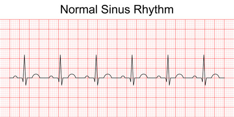Electrocardiogram show normal heart beat line (Sinus rhythm). ECG. EKG. Vital sign. Medical healthcare symbol.