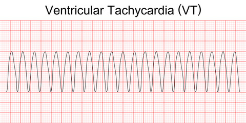 Electrocardiogram show monomorphic ventricular tachycardia (VT). Cardiac fibrillation. Heart beat. CPR. ECG. EKG. Vital sign. Life support. Medical healthcare symbol.