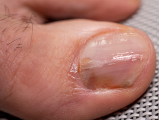 Fototapeta premium Nail infections caused by fungi such as: onychomycosis caused by dermatophytes and yeasts and for the concomitant antibacterial activity
