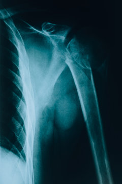 X-ray of the shoulder. Human bones. Examined by a radiologist