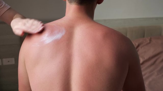 young woman hand covers muscular man bare back with white burn cream massaging against brown bed in hotel room close view