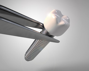 Dental implants with tweezers and white background illustration