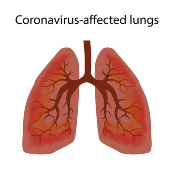 Human lungs damaged by coronavirus covid-19. The concept of the stage of damage to the respiratory tract virus. Isolated vector EPS10.