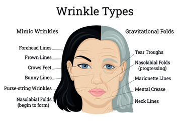 Wrinkle Types Illustration