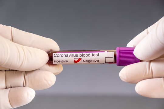 Corona virus Covid-19 blood test. Tube containing a blood sample that has tested positive for coronavirus.