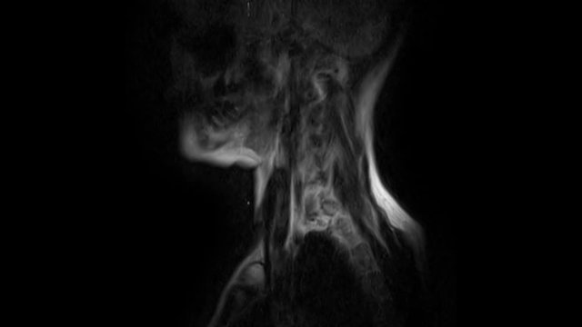 Purified MRI of the cervical spine, detection of protrusions and hernias