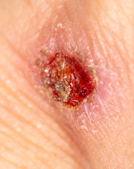 A wound from a knife cut on a person’s skin