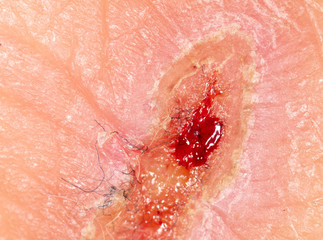 A wound from a knife cut on a person’s skin