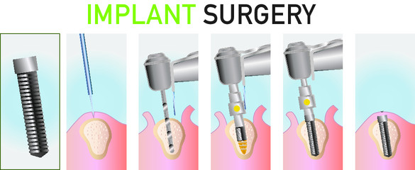 Obraz premium Implant surgery