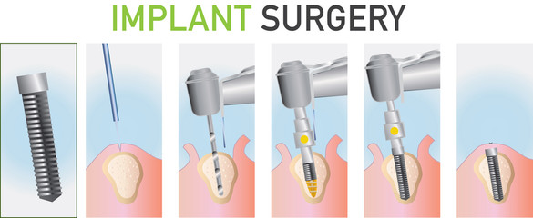 Implant surgery
