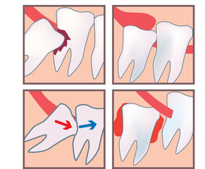tooth wisdom dissease