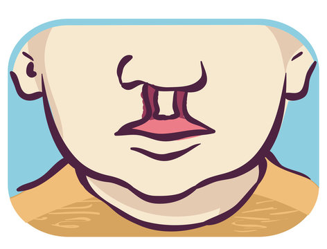 Symptom Cleft Lip Palate Bilateral Illustration