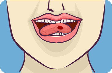 Symptom Red Blood Blister Side Tongue Illustration