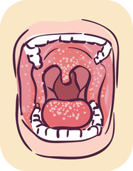 Symptoms Oral Thrush Illustration