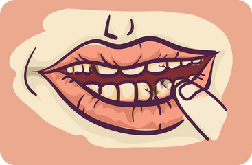 Symptoms Tooth Decay Illustration