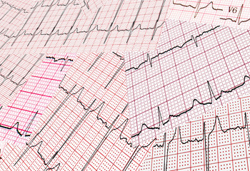 Many results of cardiogram are sparse chaotically. Abstract background