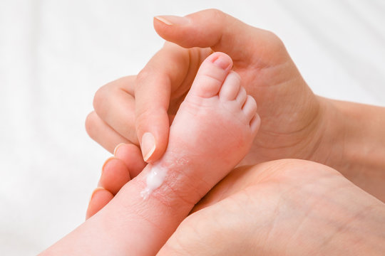 Young woman hand holding infant leg. Mother carefully applying medical ointment. Red dry skin allergy from milk formula or other food. Care about baby body. Closeup.
