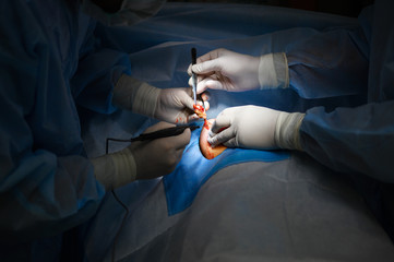Breast tumor resection. Plastic surgery